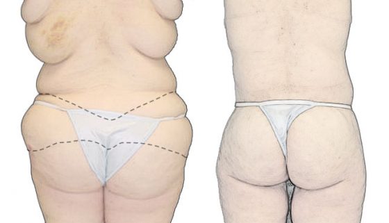 Butt lift procedure (Skin-tightening) - Dr. Rodriguez, Cosmeticsurg -  Baltimore