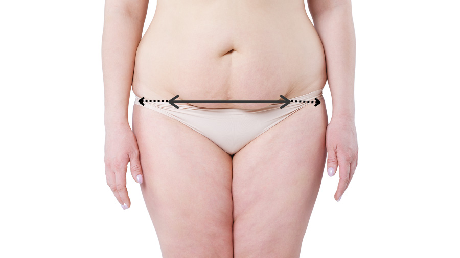 woman's torso with arrows marking standard tummy tuck incision with extended tummy tuck extension arrows