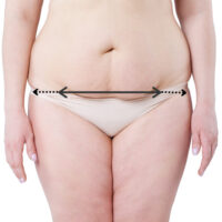 woman's torso with arrows marking standard tummy tuck incision with extended tummy tuck extension arrows