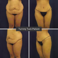 before and after photo collage of a patient who underwent an extended tummy tuck