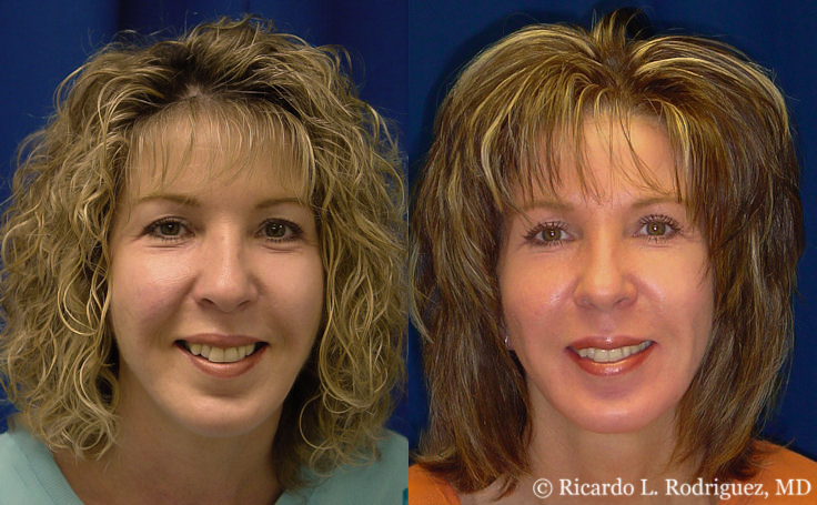 before and after facial fat transfer