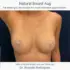 A preview of the video: Natural Breast Augmentation - Fat grafting to the breasts for a natural breast augmentation, showing a photo of a female patient before and one year after having a breast augmentation by injecting 400cc fat per breast by Dr. Ricardo L. Rodriguez, Baltimore Plastic Surgeon.