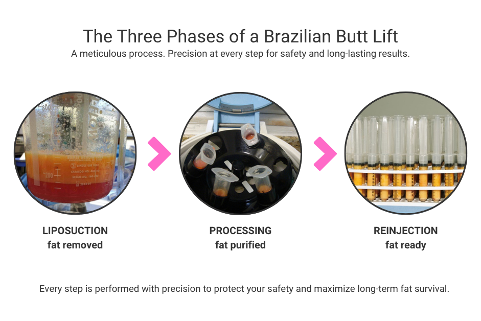 Three phases of a Brazilian butt lift: liposuction removing fat, centrifugation processing the fat, and purified fat prepared in syringes for reinjection.
