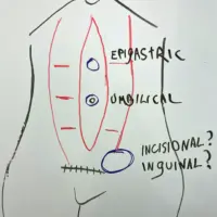 Detailed illustration of common hernia types encountered and treated during tummy tuck surgery