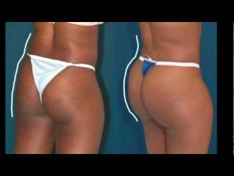 can you lose weight doing brazilian butt lift workout