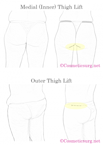 Inner Thigh Lift Punjab, Inner Thigh Lift Surgery in Punjab, Outer