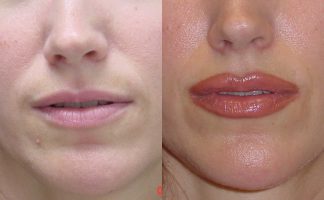 (Upper and/or Lower lip) - Dr. Cosmeticsurg -