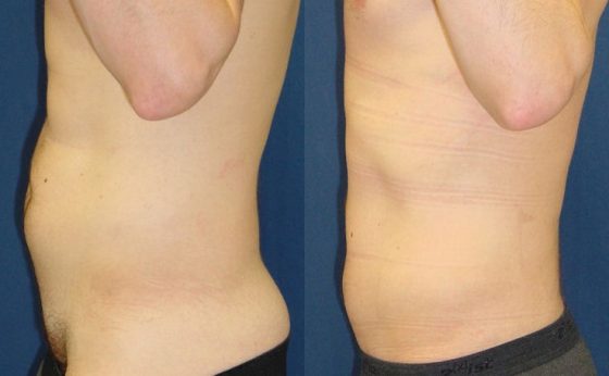 Before & After Male liposuction of love handles - Cosmeticsurg