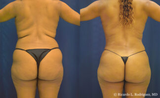 Before and after back-view photos of a 50-year-old patient who had liposuction to the abdomen, flanks, and back. The after image shows improved definition along the upper and lower back with a smoother, more contoured shape.