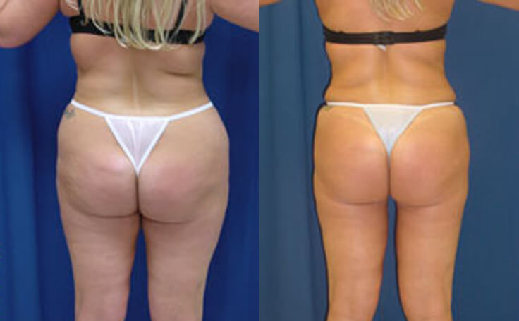 Hips liposuction: cost, procedure and results before and after