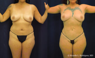 Before and after front-view photos of a 41-year-old Hispanic female patient following liposuction to the abdomen, flanks, scapular area, and sacral region. A total of 5,000cc of fat was removed, enhancing body contour and waistline definition.