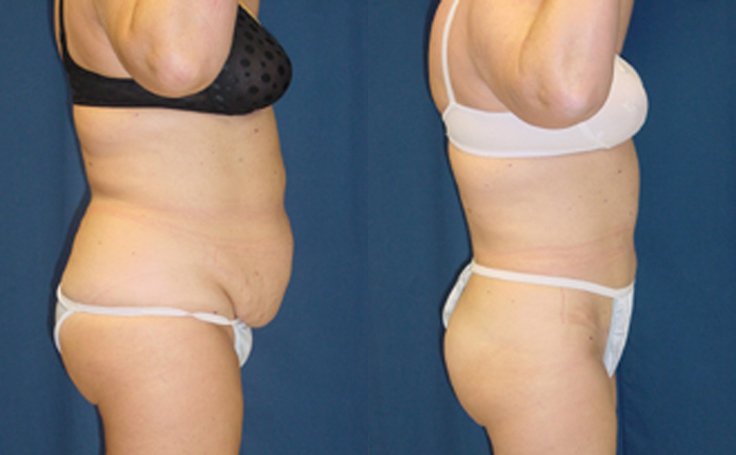 Flanks Liposuction  Before and After Photos - Palm Clinic