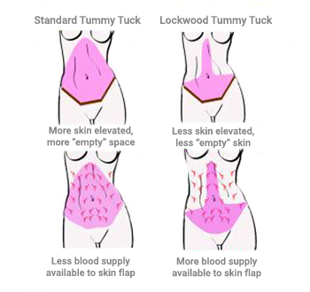 Belt Lipectomy vs. Abdominoplasty for a Complete Tummy