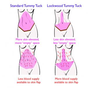 How long to wear spanx after Tummy Tuck?