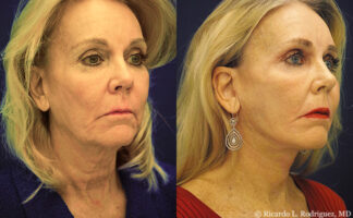 before and after a 2-step facial rejuvenation