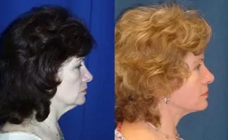 Before and after photo of an actual Neck Lift patient.