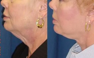 Before and after photo of an actual Neck Lift patient.