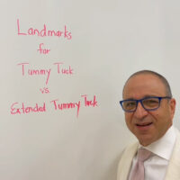 Dr. Rodriguez standing in front of his whiteboard to start his discussion about regular tummy tuck scars versus extended tummy tuck scars