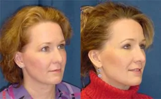 Before and after photo of an actual Rhinoplasty patient.