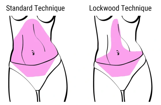 standard surgical technique vs lockwood technique illustration