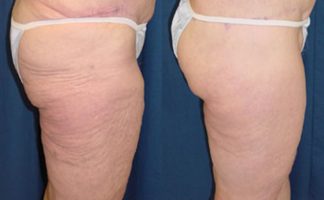 Thigh lift before & after photos - Dr. Rodriguez, Cosmeticsurg