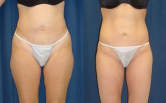 Should I get a second opinion 1.5 weeks after inner thigh lipo and