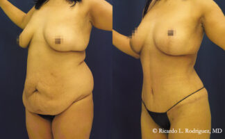 before and after an extended tummy tuck with lipo and a breast lift