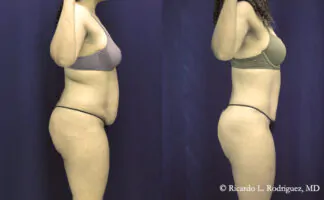 tummy tuck with liposuction patient before and after